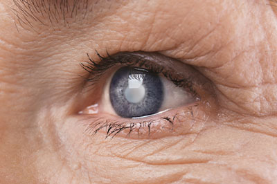 Glaucoma Eye Care Texas A M
